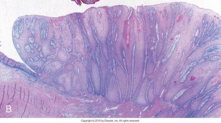 Proliferativ verrucøs hyperplasi Proliferativ verrucøs