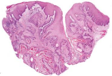 Variant: carsinoma cuniculatum Parallell i