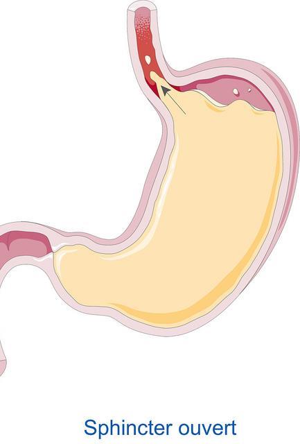 Refluks Symptomer Oppkast og gulping Smerter i brystet og øvre del av magen