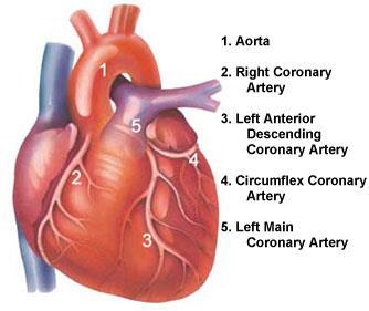 Akutt koronarsyndrom Arteriosklerose med forsnevringer i hjertets koronarkar