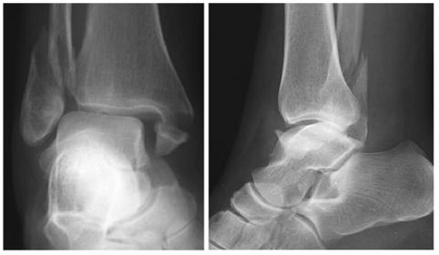 PROM forskning Ett-årsresultater etter operasjon for ankelbrudd eller Hallux Valgus Ankelbrudd: heterogen populasjon, kort oppfølgning Operativ/konservativ