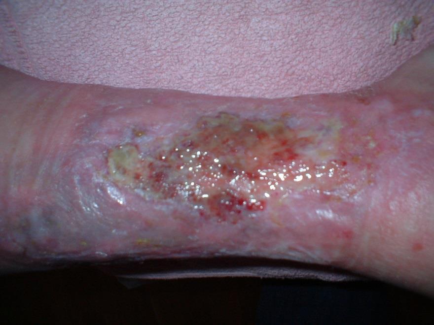Biofilm i kroniske sår Bakterier danner biofilm som hemmer sårhelingen 60%-100% av alle ikke-helende sår har