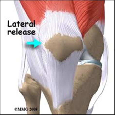 Kirurgisk behandling: Lateral release, eller fly ng av festet for kneskjel-senen/ venteromedialisering, OM OPERASJONEN Lateral release Ved funn av feils lling/ lt av kneskjelet/ patella kan ein