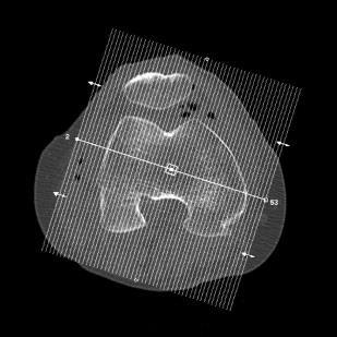 Transversalt, coronalt og sagittalt. 2/2 mm. Algoritme: bein.