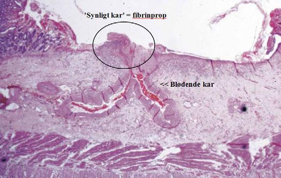 Figur 1. Histologisk snitt av ulcusbunnen med et såkalt synlig kar. Forrest klassifikasjonen anvendes for å vurdere hvilke ulcera som krever endoskopisk behandling Tabell 3.