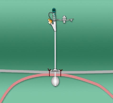 Direkte punksjons PEG Lysgjennomskinnelighet og kontroll med gastroskopet er også her en forutsetning. Settet inneholder et sutursett med hvilket det settes tre suturer.