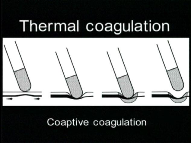 Figur 8. Prinsippet ved koaptiv koagulation. Ved APC oppnås hemostase alene ved en termisk effekt i vevet omkring blodkaret.