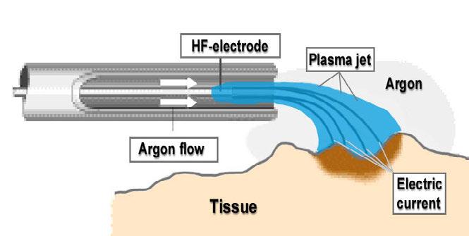 Argonplasma koagulasjon (APC) innebærer koagulasjon ved hjelp av ionisert argongass. I forhold til GI blødning er metoden spesielt egnet ved slimhinneblødninger, angiodysplasier og GAVE. Figur 10.