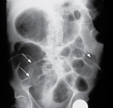 Side 14 av 30 Den foretrukne røntgenologiske metoden i slike tilfeller er CT-abdomen og bekken med oral og intravenøs kontrast.