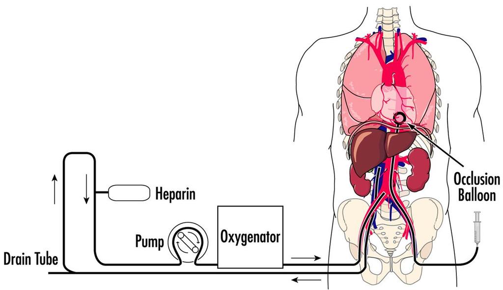 de første cdcd med normotherm ECMO i Scandinavia I 2014 gjennomførte OUS 2 organdonasjoner med bruk av Ekstra Corporal Membran Oksygenator (ECMO) hos pasienter som døde av hjerte- og