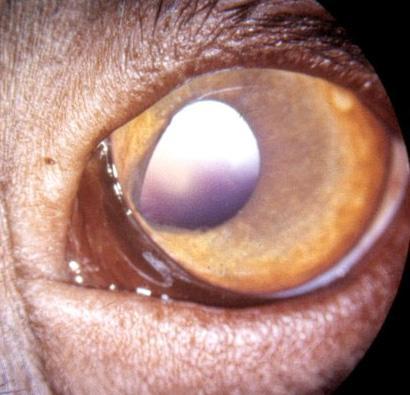 Ufullstendig lukking av denne fissuren resulterer i defekter i en eller flere strukturer i øyet, colobom (fig.1.5).