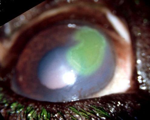 Siden dette er en bilateral lidelse der basalmembranene i begge hornhinner er affisert, bør begge øyne undersøkes ved hver kontroll. Figur 8.