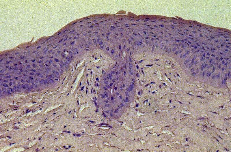 Figur 8.12 Heling av overflatisk stromalt corneasår. Såret heler ved at det fylles med epitelceller. Dypere stromal sår heler ved innvekst av blodkar og arrdannelse 8.5.