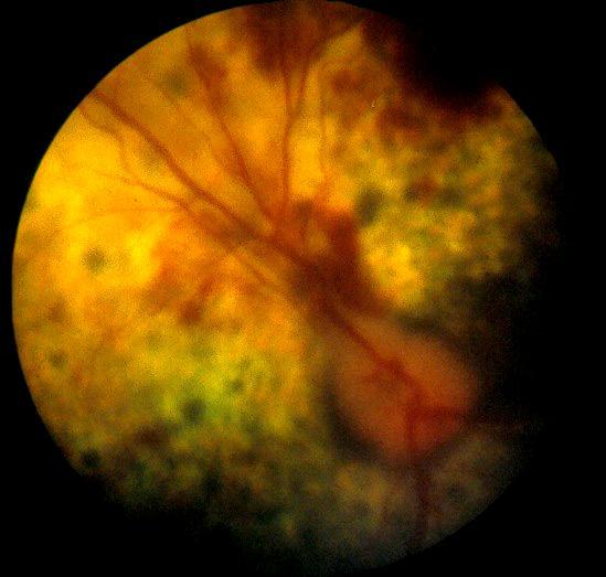 at retina løsner fra pigmentepitelet. Retinaløsninger kan være partielle eller totale.