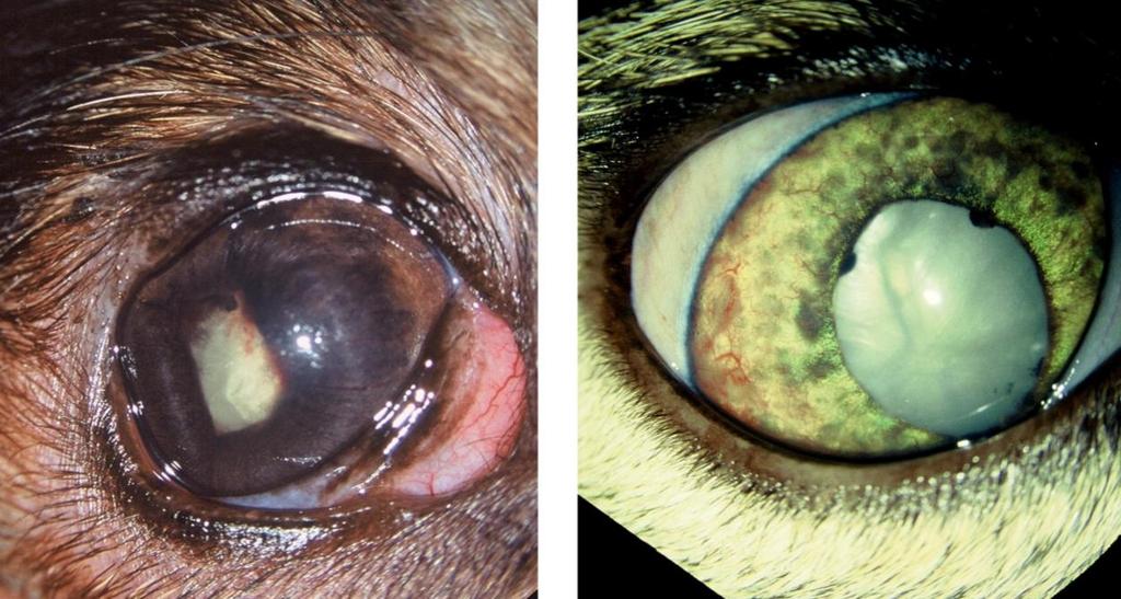 Figur 9.17 Iris bombé med syneki mellom iris og fremre linsekapsel. Dette hindrer kammervæsken i å strømme gjennom pupillåpningen, og det intraokulære trykket stiger Figur 9.