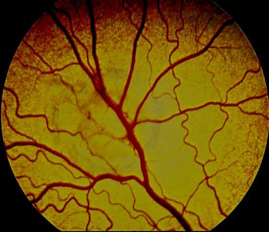 12 SYKDOMMER I RETINA OG NERVUS OPTICUS Innhold Utviklingsforstyrrelser Inflammasjoner Retinaløsning Optisk neuritt Degenerasjoner Retinaforandringer sekundært til systemisk sykdom 12.