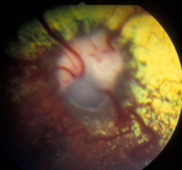 Choroidea er unormalt utviklet med store, uregelmessige chorioidal-kar (fig.12.2). Mellom karene ses den hvite sklera. Retina kan også være feilutviklet i dette området. Figur 12.2 Collie eye anomaly.
