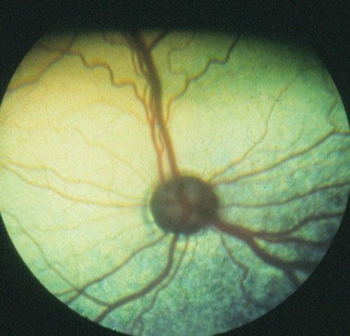 12.1.2.3 Retinaløsning Retinaløsning ses som komplikasjon til CEA og forårsaker nedsatt syn eller blindhet.