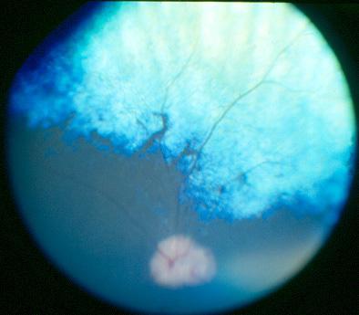 Tidlig stav-tapp-degenerasjon (early retinal degeneration - erd) er også beskrevet fra USA hos norsk elghund.