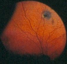 12.2.3 Inflammasjoner Retina har begrenset evne til regenerasjon, og betennelsesforandringer er derfor ofte irreversible med atrofi av affiserte deler av retina.