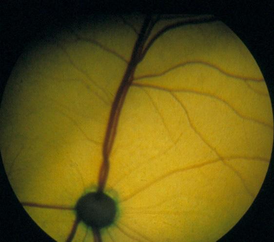 et direkte oftalmoskop, god forstørrelse, men ikke så god oversikt som et indirekte oftalmoskop. 3.10.