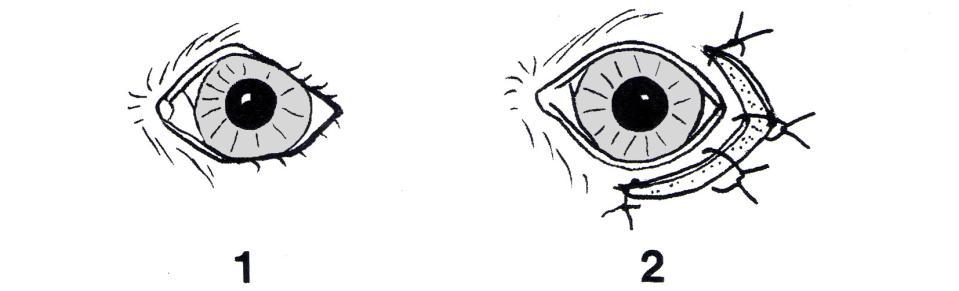 Figur 5.10 Ved entropion er ofte laterale øyevinkel og litt av laterale øvre øyelokk medinndratt, og snittet må legges slik at øyespalten gjøres mer åpen.