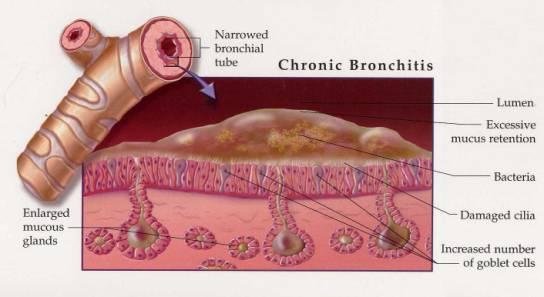 Püsiobstruktsiooni mehhanismid kroonilise bronhioliidi ( hingamisteede tüüpi KOK) korral Norm KOK (COPD) Anatomical Chart Company, Skokie, IL, USA Lima hüpersekretsioon
