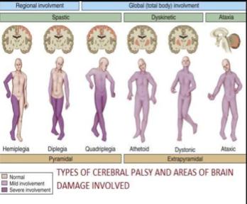 Intrapartum feber og Cerebral Parese Populasjon-basert case-control studie >2500g 48 spastisk CP /378 controller IPF øker risiko for CP OR 9.3 (95% CI 2.7-31) J. K. Grether and K. B. Nelson.