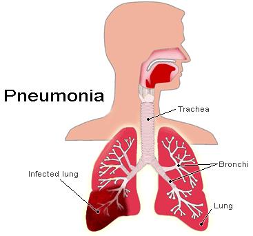 Lungebetennelse (pneumoni) Bind 1 s 76-78 En infeksjon i lungevevet. Skyldes for det meste bakterier, men kan også skyldes virus og sopp.