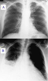 Risikofaktorer for å utvikle pneumoni Høy alder Annen lungesykdom Annen alvorlig sykdom (diabetes, hjerneslag og hjertesvikt) Alkoholmisbruk