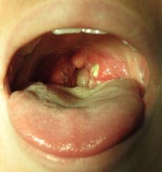 Tonsilitt (halsbetennelse) Betennelse i tonsillene (mandlene) Kan skyldes bakterier (streptokokker) Faryngitt (forkjølelse) Betennelse i farynks