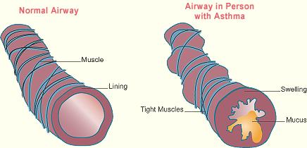 Astma - Bind 1 s 70-71 Anfallsvis opptreden av pustebesvær som følge av