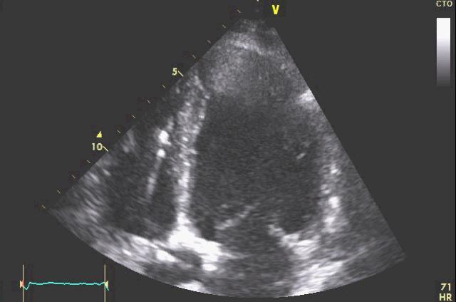 MAP 60 mmhg MAP 60 mmhg