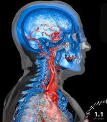 Renal nerveablasjon Bestillerforum: hurtig metodevurdering Embolektomi ved akutt hjerneslag: Strålevernets