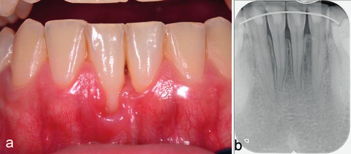 Figur 7. Kasus 2: Gingival retraksjon labialt på tann 31 og 41 (a). Røntgenbilde av tann 31 og 41 viser et mesialt festetap på ca. 2 mm (b) Figur 8.