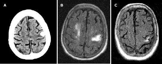 A B C Acute superficial lobar hemorrhage in the left frontal lobe seen on CT scan in a patient with cerebral amyloid angiopathy Flair MR image performed one week later shows the high signal intensity