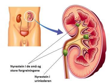 Kjemoterapi og stråling Prognose Omtrent halvparten overlever i over fem år. Nyrestein side 125 Utfelling av steiner i nyre eller urinveier.