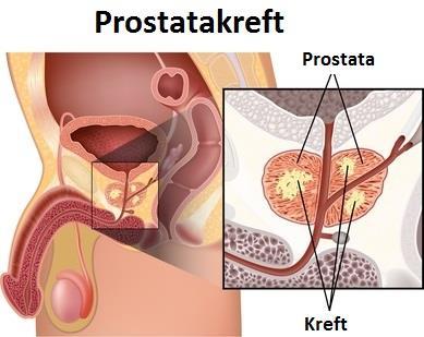 Prostatakreft, forts. Prostatakreft, forts.