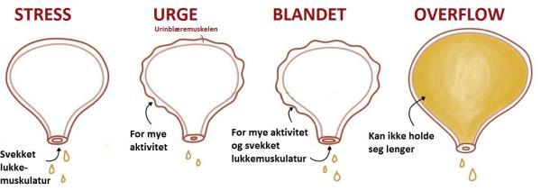 Stressinkontinens Urinlekkasje i forbindelse med økning av trykket inne i bukhulen, f.eks. ved hoste, løft, latter etc.