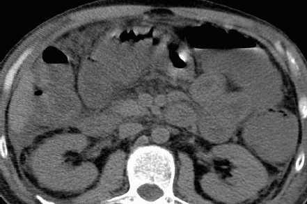 Cocaine ischemia & bowel rupture