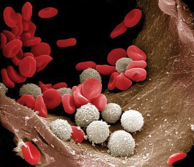 Lav hemoglobinverdi = anemi ( blodfattig ) Symptomer Tretthet, svimmelhet, tungpust.