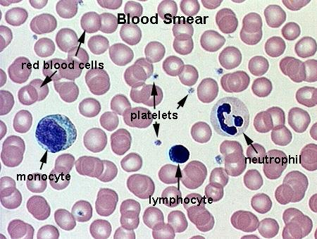 Leukocytter Leukocytter og immunaktivering Når immunsystemet aktiveres, vil leukocyttene fra benmargen frigjøres til blodet (leukocytose økt antall).