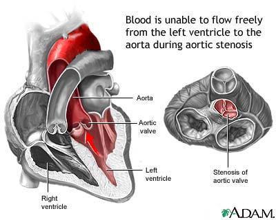 Klaffesykdommer Stenoser Stivere klaffer. F.eks. aortastenose, vanskeligere for blodet å strømme fra venstre ventrikkel til aorta. Insuffisienser Lekke klaffer. F.eks. mitralinsuffisiens.