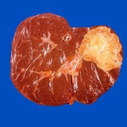 Cirrhose Hepatocellulært