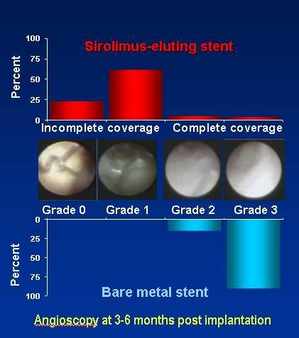Forsinket tilhelning og re-endotelialisering ved DES Forsinket og inkomplett dekning av stentene med endotelceller, hypersensitivitet og inflammasjon i karveggen samt fibrinnedslag.