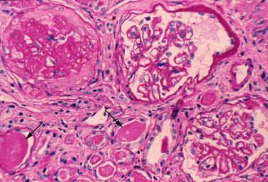 Fortykket arteriolevegger, ofte med hyaline forandringer (sees ikke på bildet). Glomeruli viser global sklerose.