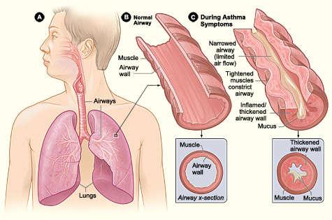 It is defined by: the history of respiratory symptoms such as wheeze, shortness of breath, chest