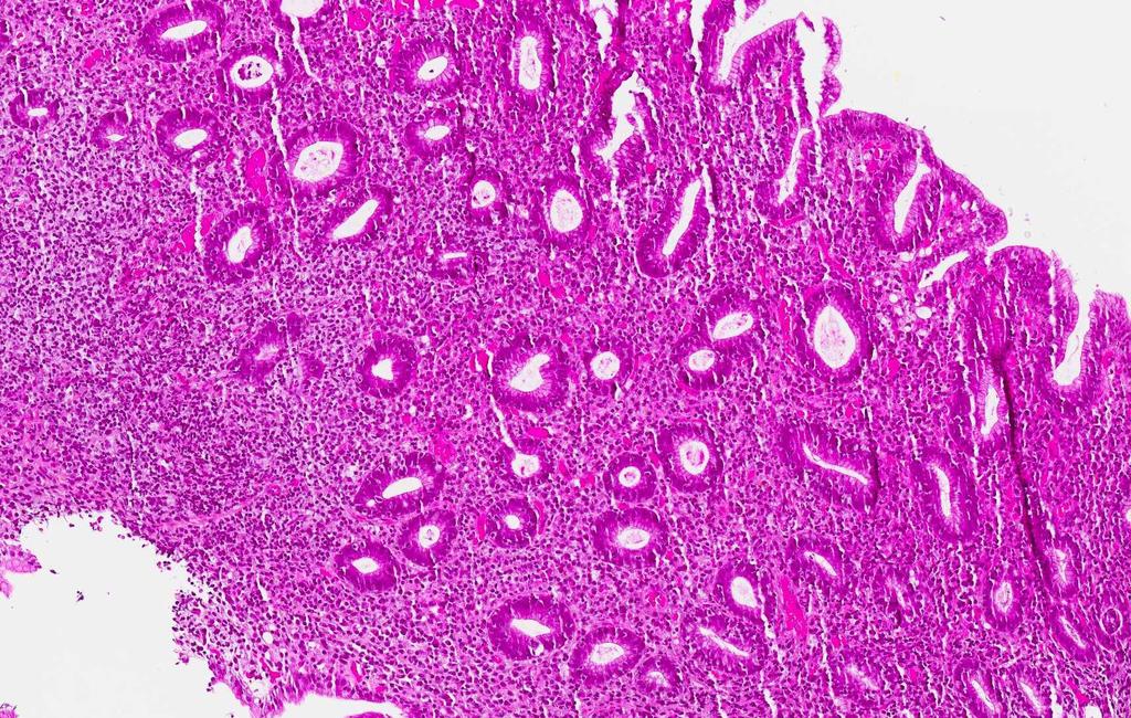 Marginalsonelymfom (MALT) (marginal zone lymphoma= MZL) H.