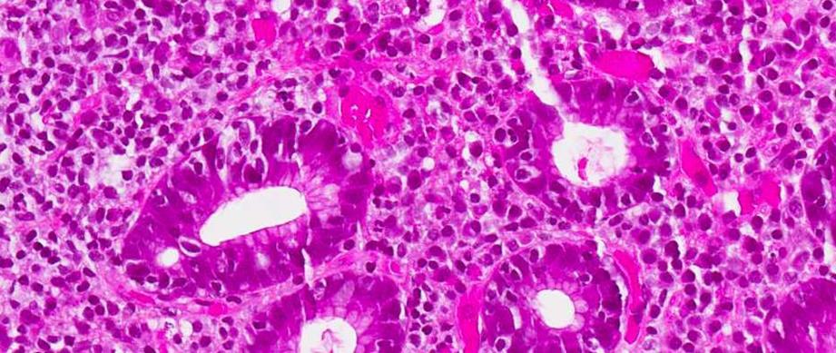 Marginalsonelymfom Heterogene små til middels store B-celler Infiltrerer kjertelepitel (lymfoepiteliale lesjoner): aggregater av >3 MZL-celler med endring/