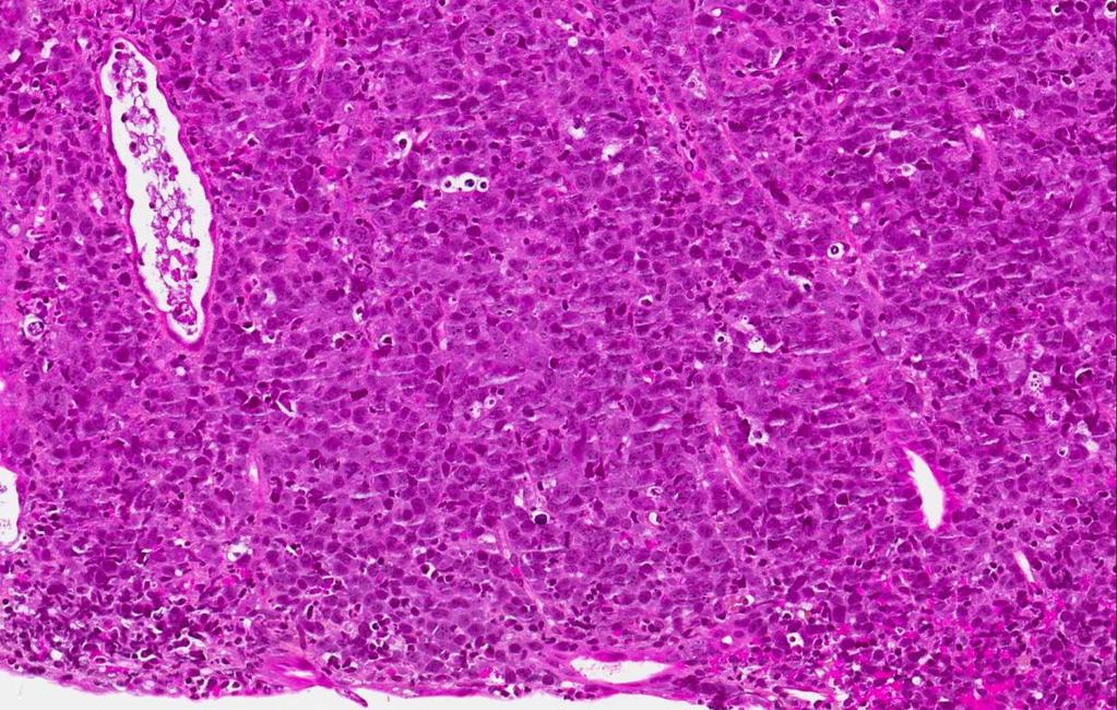 Diffust storcellet B-cellelymfom (diffuse large B-cell lymphoma, DLBCL)